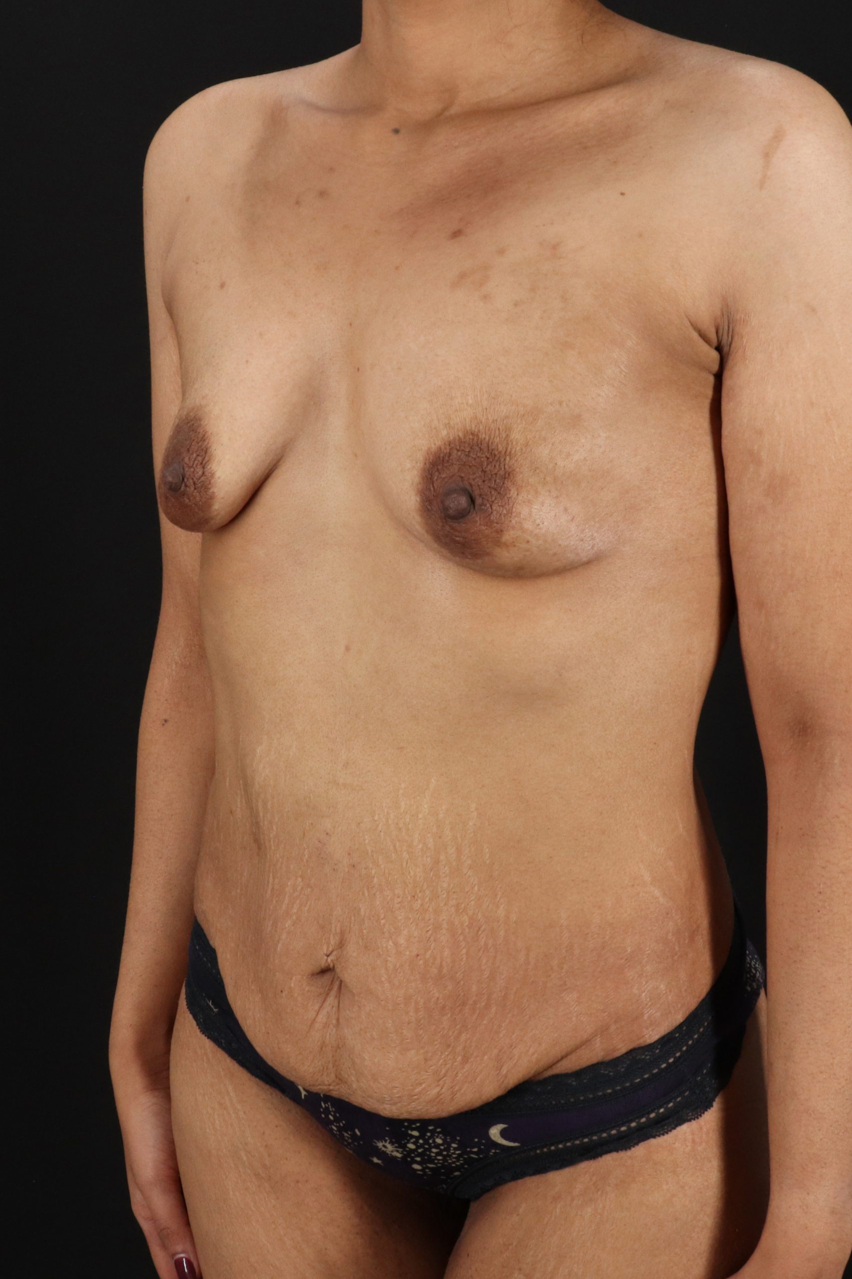 All Me Augmentation Before & After Patient #2119