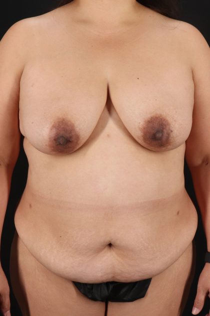 All Me Augmentation Before & After Patient #2120
