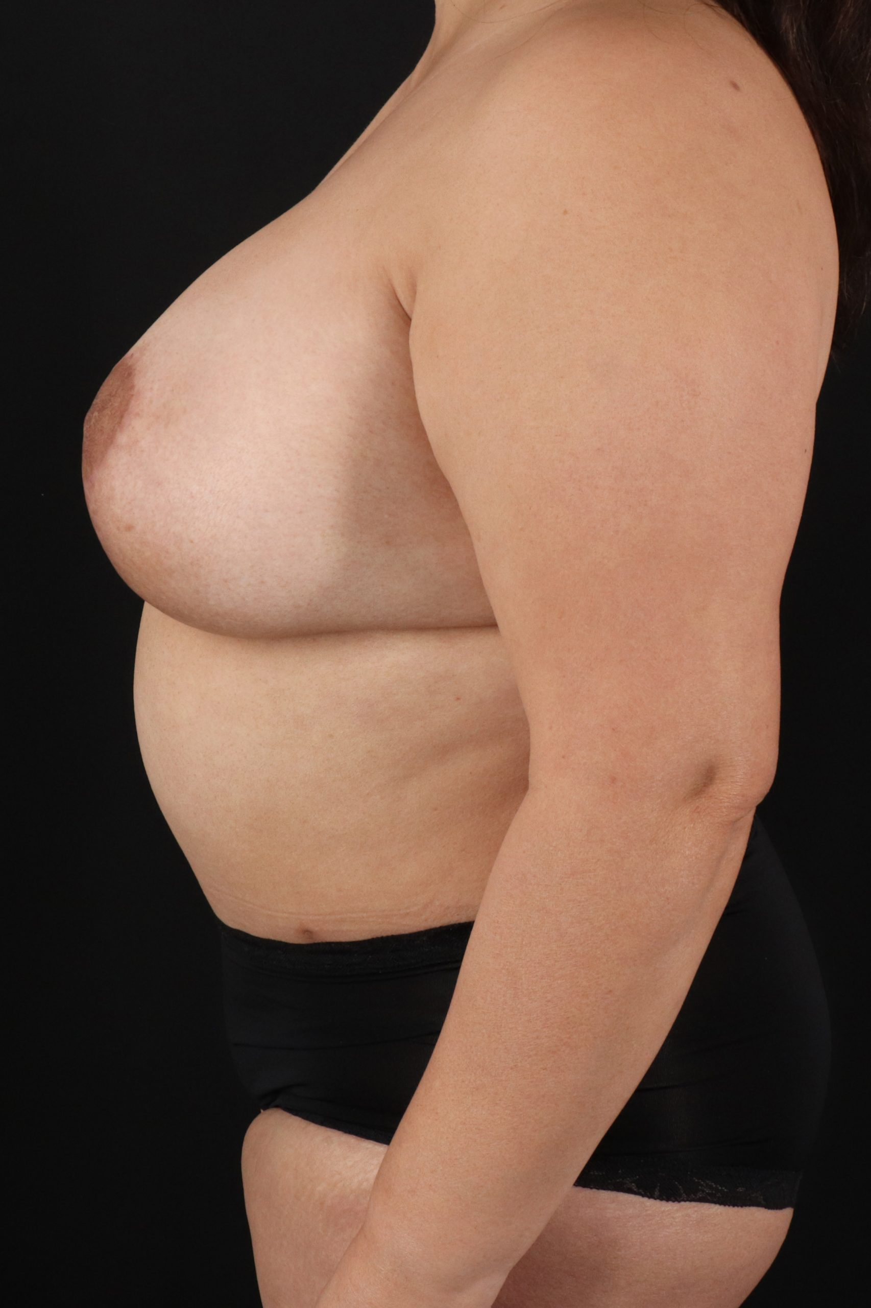 All Me Augmentation Before & After Patient #2120