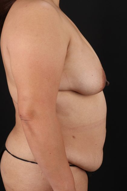 All Me Augmentation Before & After Patient #2120