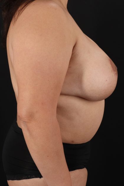 All Me Augmentation Before & After Patient #2120