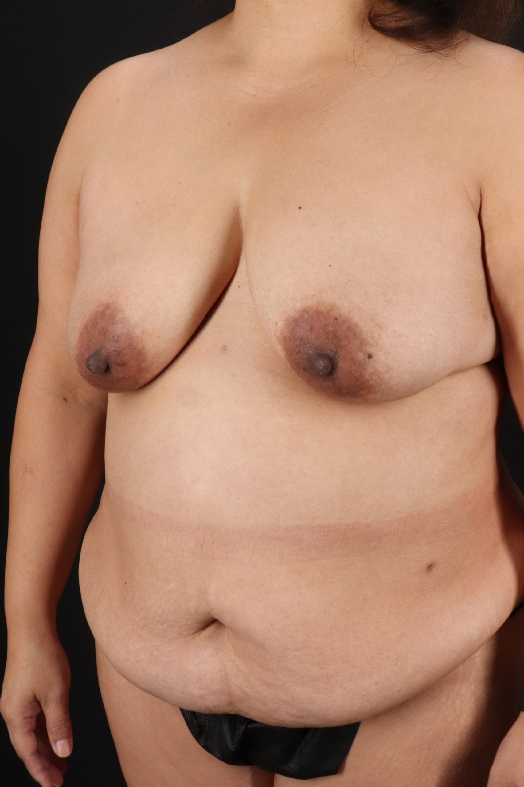 All Me Augmentation Before & After Patient #2120