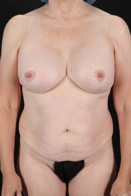 All Me Augmentation Before & After Patient #1897