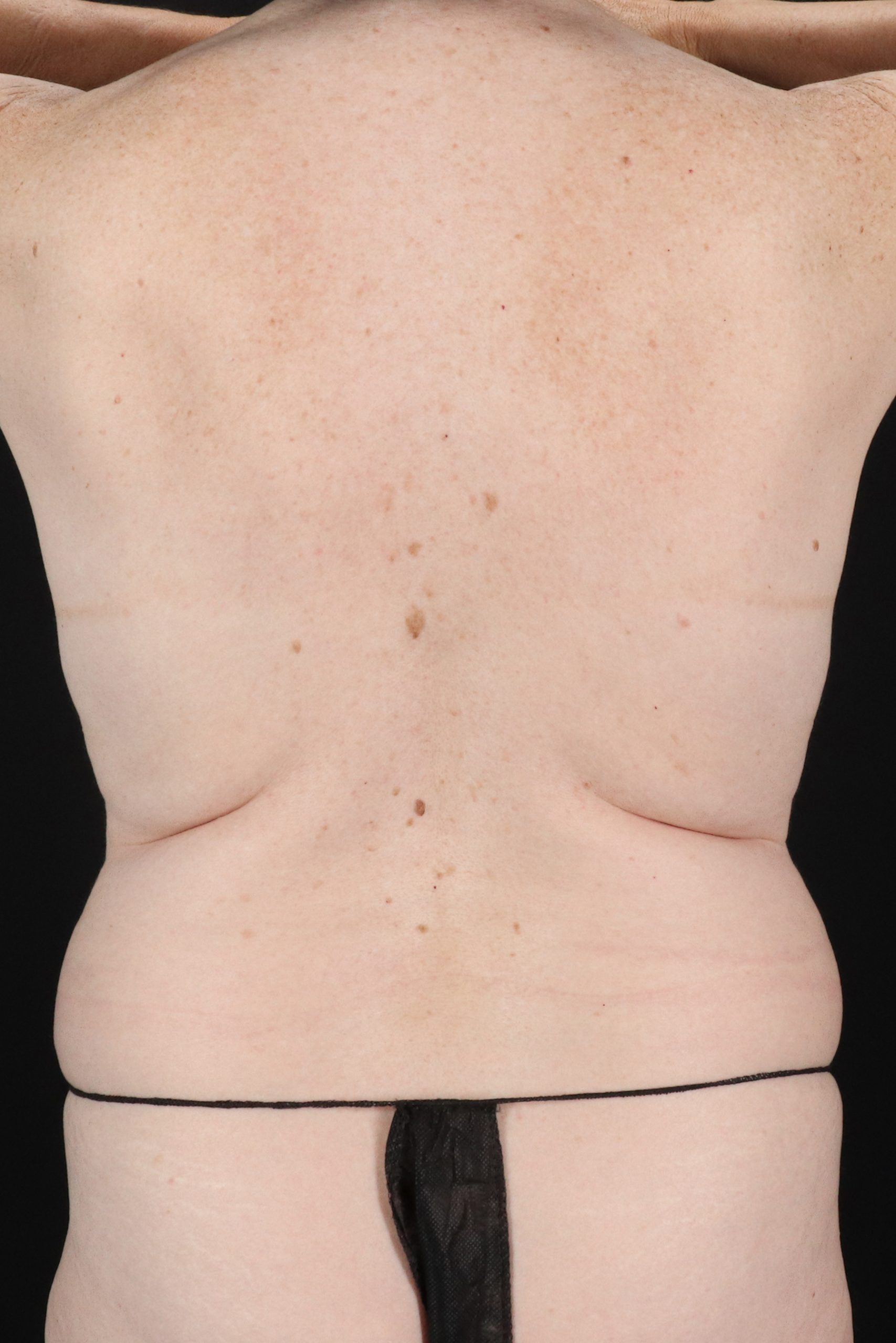 All Me Augmentation Before & After Patient #1897