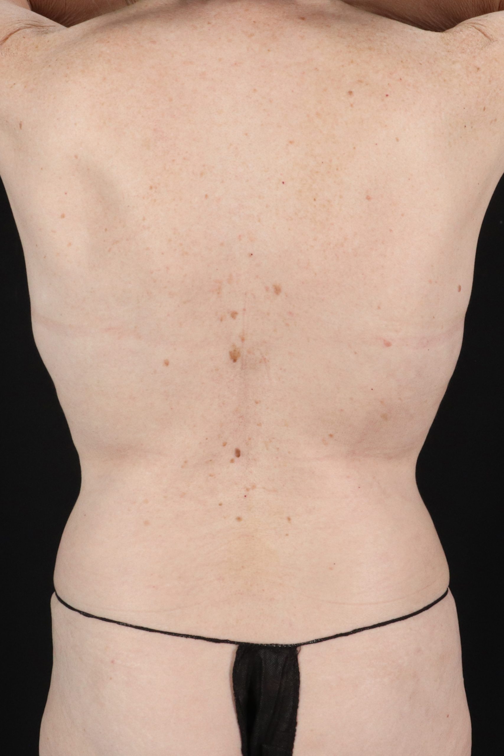 All Me Augmentation Before & After Patient #1897