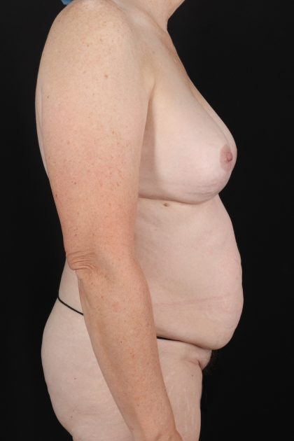 All Me Augmentation Before & After Patient #1897