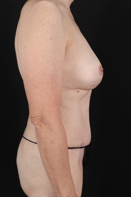 All Me Augmentation Before & After Patient #1897
