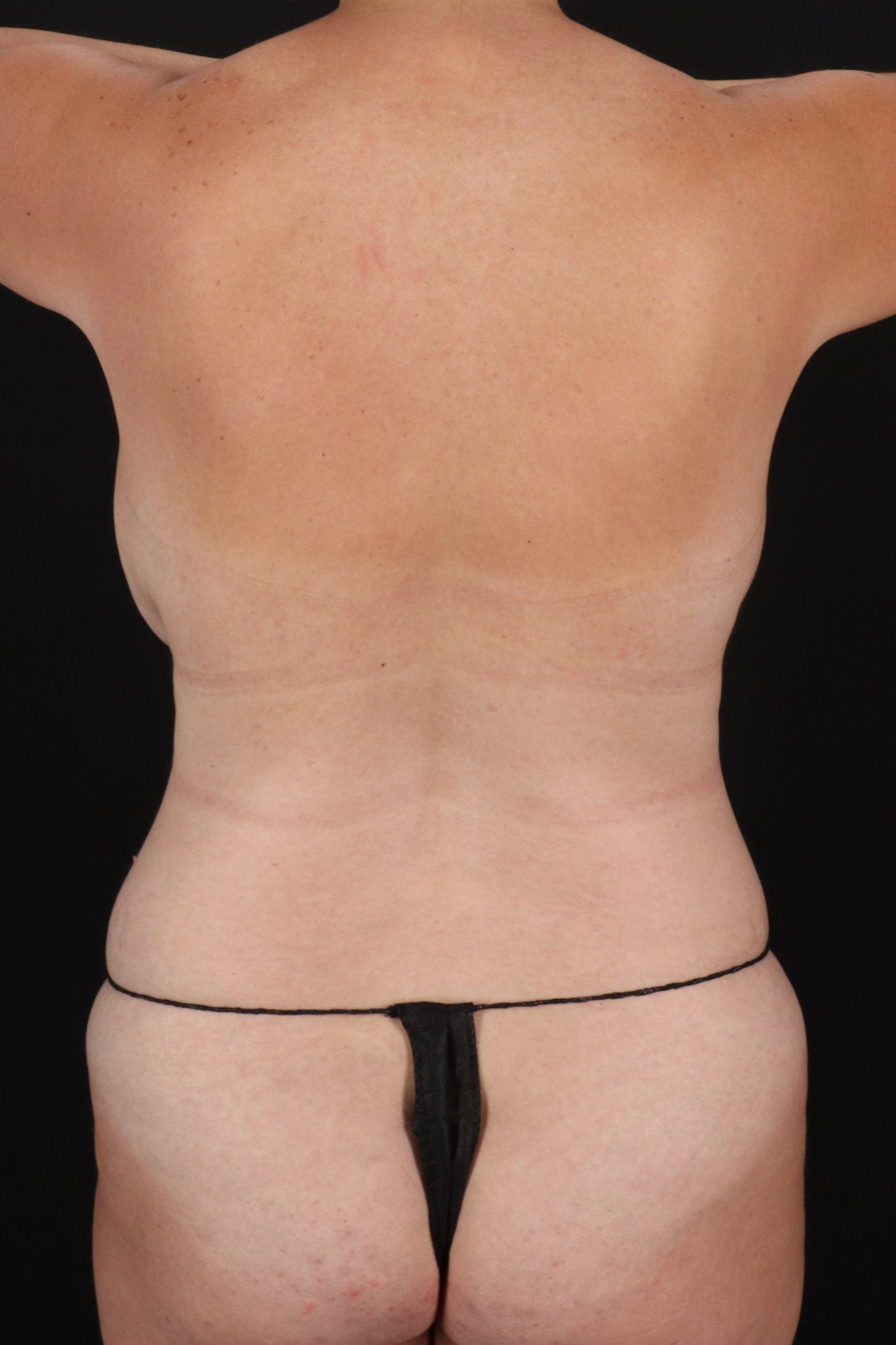 All Me Augmentation Before & After Patient #1898