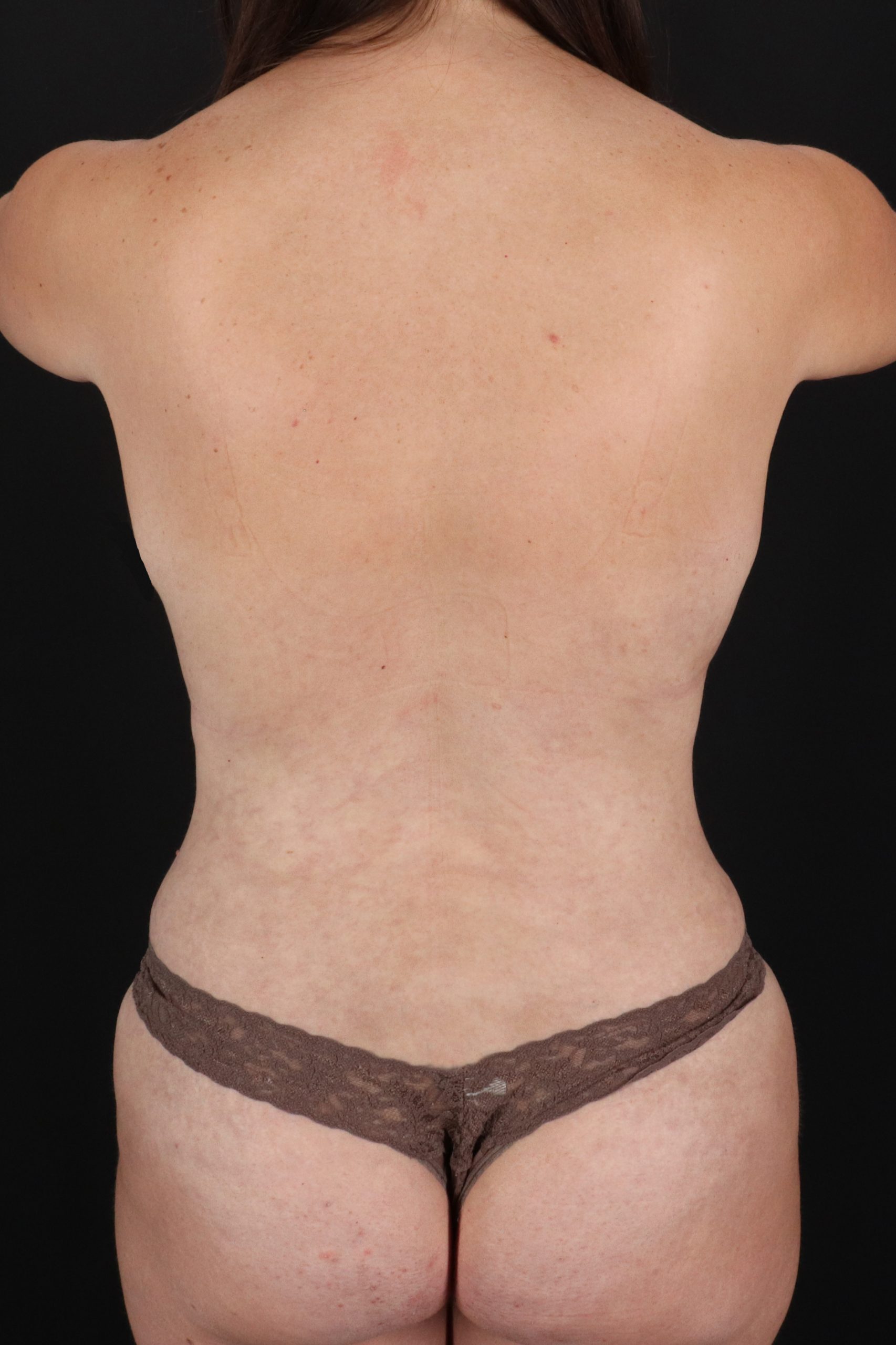 All Me Augmentation Before & After Patient #1898