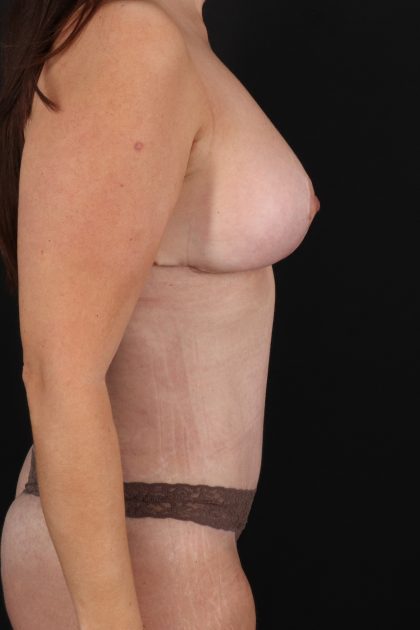 All Me Augmentation Before & After Patient #1898