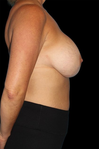 All Me Augmentation Before & After Patient #1900