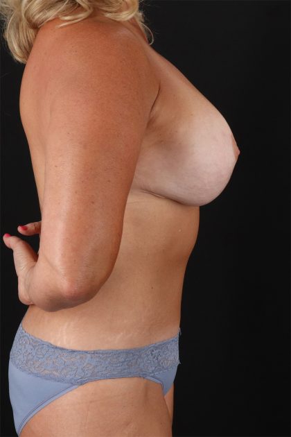 All Me Augmentation Before & After Patient #1900