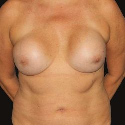 All Me Augmentation Before & After Patient #1741