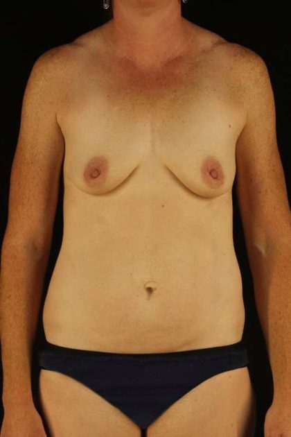 All Me Augmentation Before & After Patient #1762