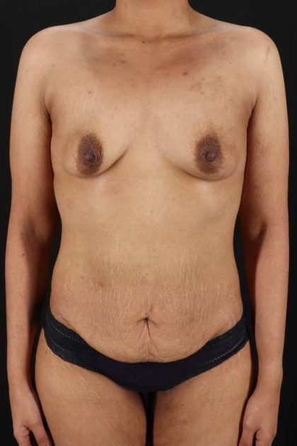 All Me Augmentation Before & After Patient #1769