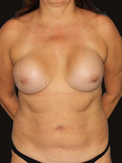 All Me Augmentation Before & After Patient #1741