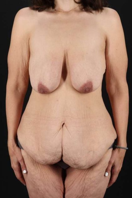 All Me Augmentation Before & After Patient #1790