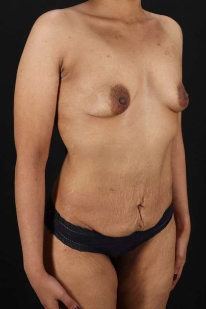 All Me Augmentation Before & After Patient #1769