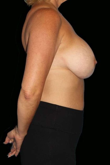 All Me Augmentation Before & After Patient #1755