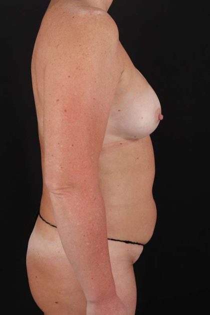 All Me Augmentation Before & After Patient #1818