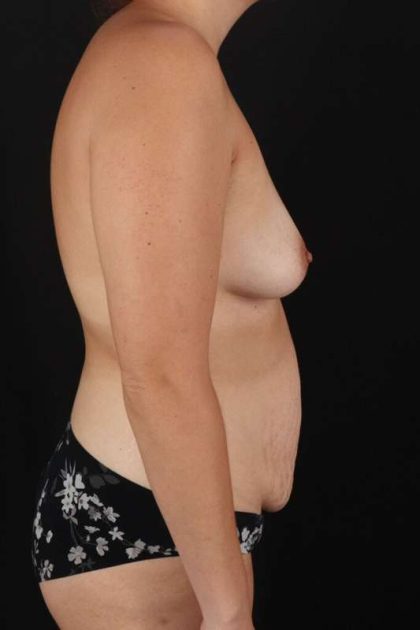 All Me Augmentation Before & After Patient #1825