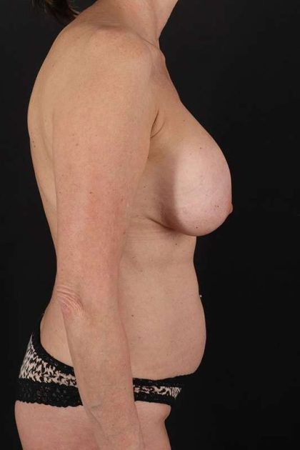 All Me Augmentation Before & After Patient #1832
