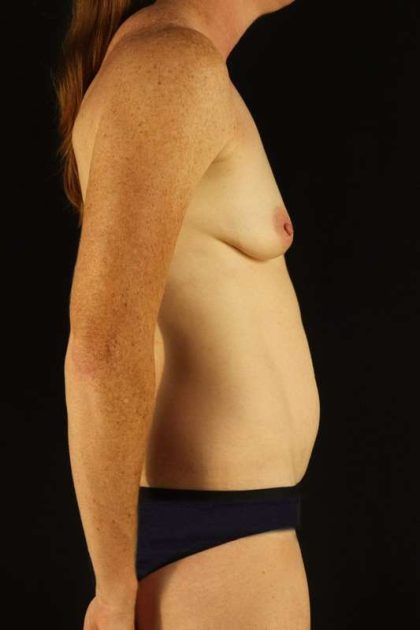 All Me Augmentation Before & After Patient #1762