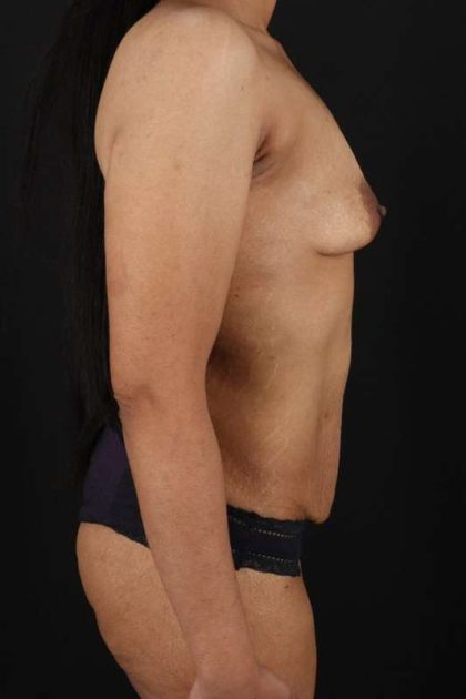 All Me Augmentation Before & After Patient #1769