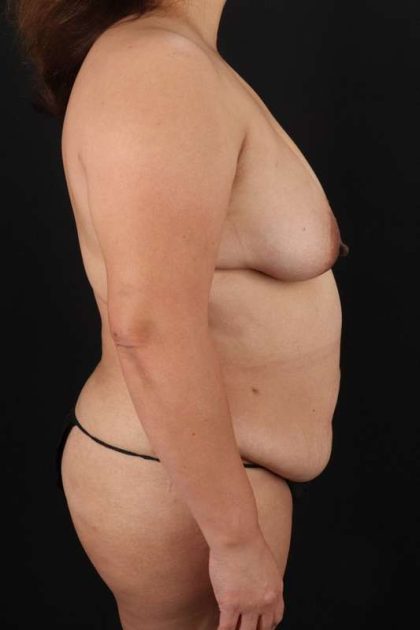 All Me Augmentation Before & After Patient #1776