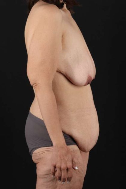 All Me Augmentation Before & After Patient #1790