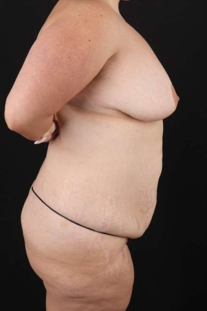 All Me Augmentation Before & After Patient #1804
